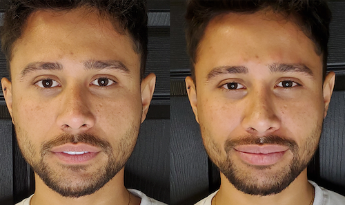 Smooth Lip Contours Before After Mississauga Lip Doctor